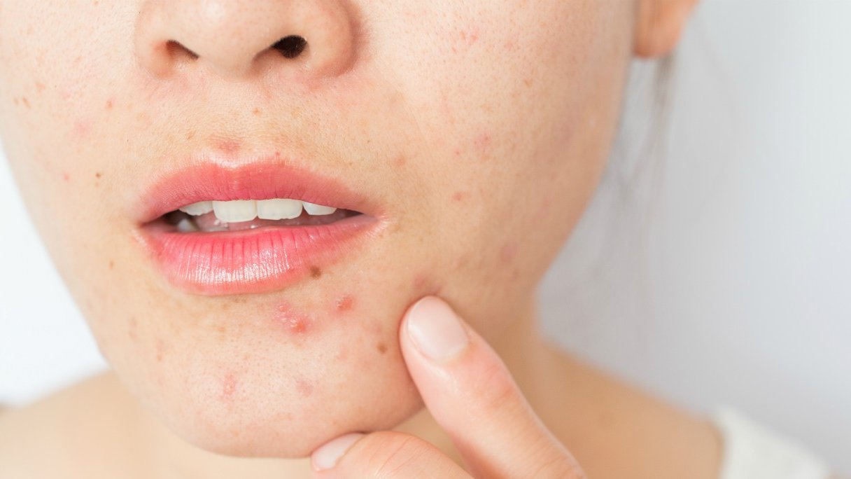 Middel tegen acne veroorzaakt depressie  Gezondheidsnet